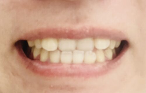 矯正前の歯